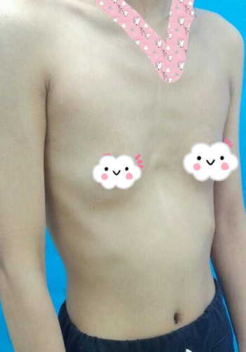 深圳假體隆胸讓平胸妹華麗變身，手術果分享