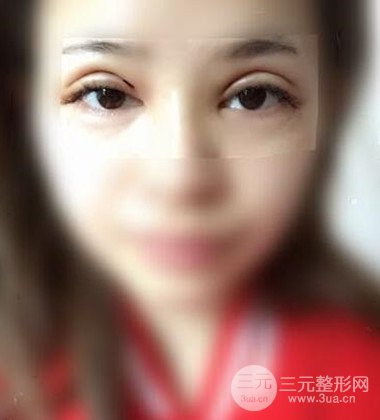 上海雙眼皮手術(shù)真人案例恢復(fù)過程分享