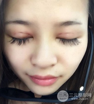 上海雙眼皮手術(shù)真人案例恢復(fù)過程分享