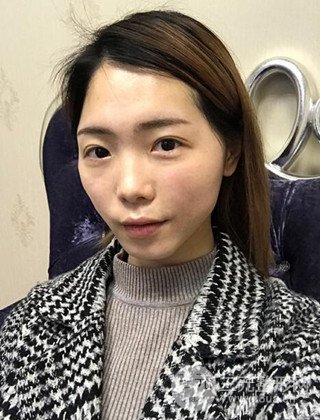 在上海諾詩(shī)做了自體脂肪填充全臉真人案例大曝光