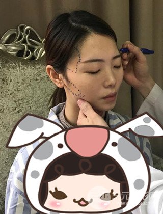在上海諾詩(shī)做了自體脂肪填充全臉真人案例大曝光