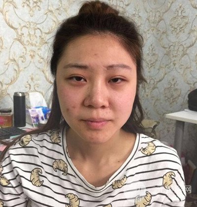 隆鼻整形+埋埋蛋白線.提升+自體脂肪全臉填充術(shù)后改頭換面！