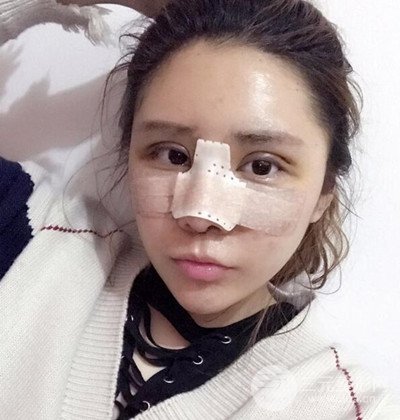 隆鼻整形+埋埋蛋白線.提升+自體脂肪全臉填充術(shù)后改頭換面！