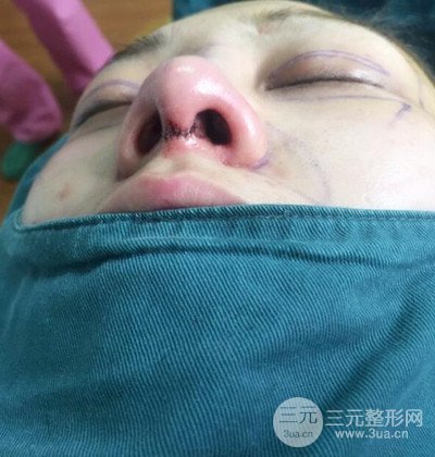 隆鼻整形+埋埋蛋白線.提升+自體脂肪全臉填充術(shù)后改頭換面！