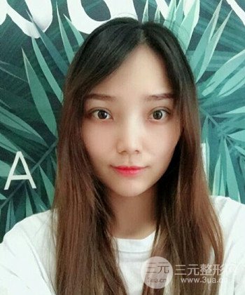 雙眼皮失敗修復(fù)手術(shù)日記分享,改變雙眼皮不對稱
