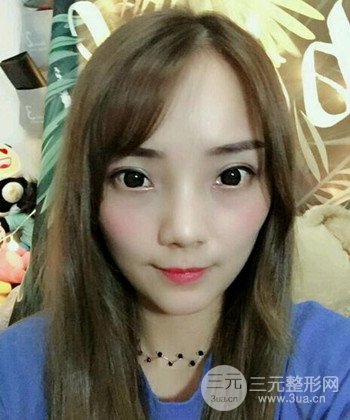 雙眼皮失敗修復(fù)手術(shù)日記分享,改變雙眼皮不對稱