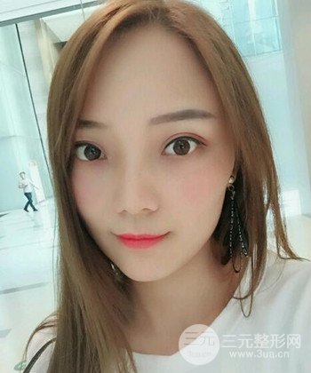 雙眼皮失敗修復(fù)手術(shù)日記分享,改變雙眼皮不對稱