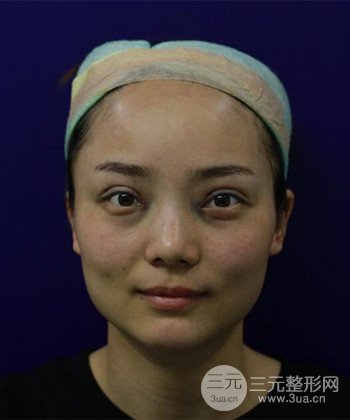 雙眼皮失敗修復(fù)手術(shù)日記分享,改變雙眼皮不對稱