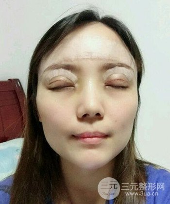 雙眼皮失敗修復(fù)手術(shù)日記分享,改變雙眼皮不對稱