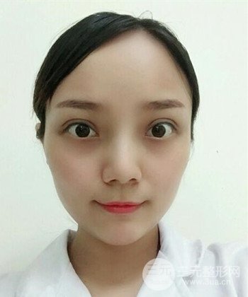 雙眼皮失敗修復(fù)手術(shù)日記分享,改變雙眼皮不對稱