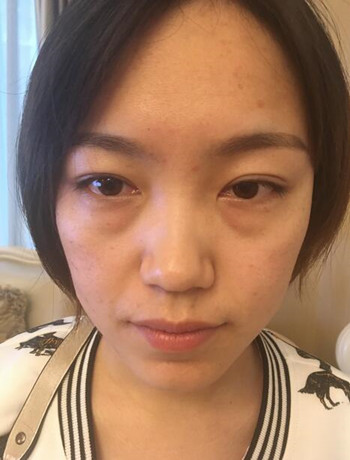 北京內(nèi)切祛眼袋真人案例果對比分享，年輕十歲不是夢