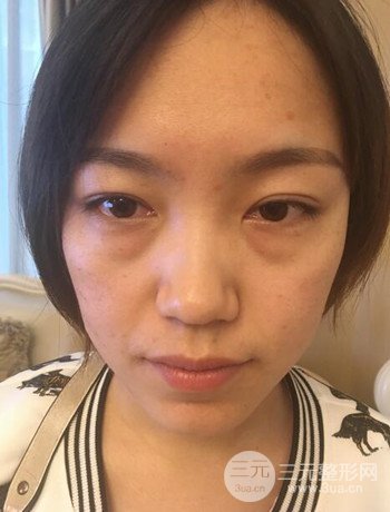 北京內(nèi)切祛眼袋真人案例果對(duì)比分享,年輕十歲不是夢(mèng)