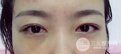 北京內(nèi)切祛眼袋真人案例果對(duì)比分享,年輕十歲不是夢(mèng)