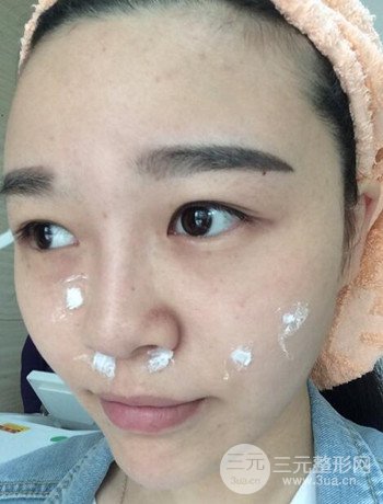 北京激光去雀斑真實(shí)案例分享，純素顏無濾鏡果圖