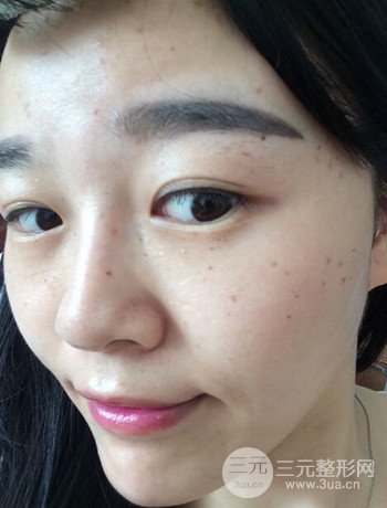 北京激光去雀斑真實(shí)案例分享，純素顏無濾鏡果圖