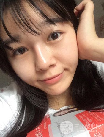北京激光去雀斑真實(shí)案例分享，純素顏無濾鏡果圖