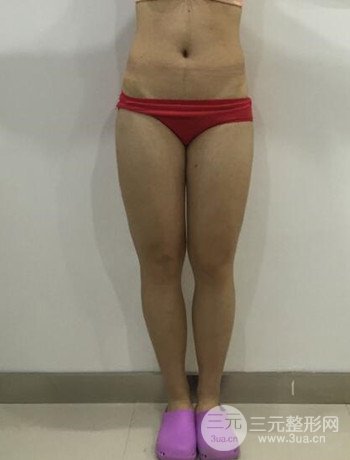 吸脂瘦大腿手術(shù)經(jīng)歷分享，纖細(xì)雙腿不再是夢(mèng)