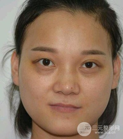 切開雙眼皮術(shù)后改良雙眼不對(duì)稱，恢復(fù)果圖分享