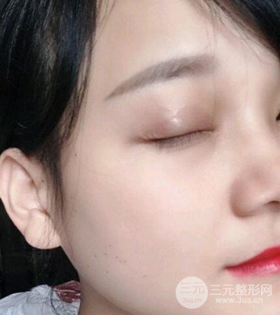 切開雙眼皮術(shù)后改良雙眼不對(duì)稱，恢復(fù)果圖分享