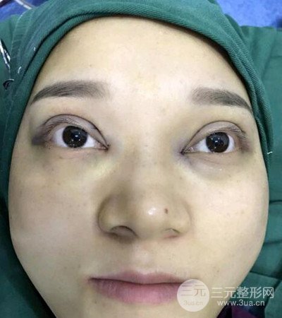 切開雙眼皮術(shù)后改良雙眼不對(duì)稱，恢復(fù)果圖分享