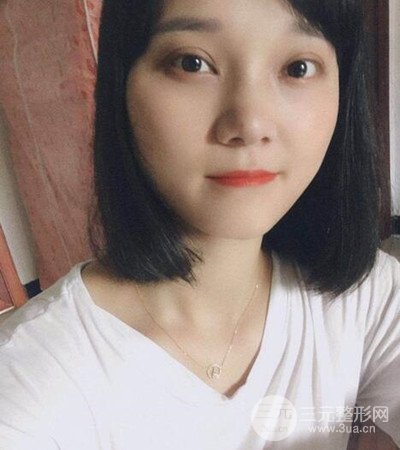 切開雙眼皮術(shù)后改良雙眼不對(duì)稱，恢復(fù)果圖分享