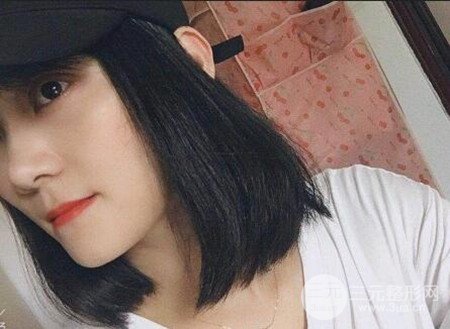 切開雙眼皮術(shù)后改良雙眼不對(duì)稱，恢復(fù)果圖分享