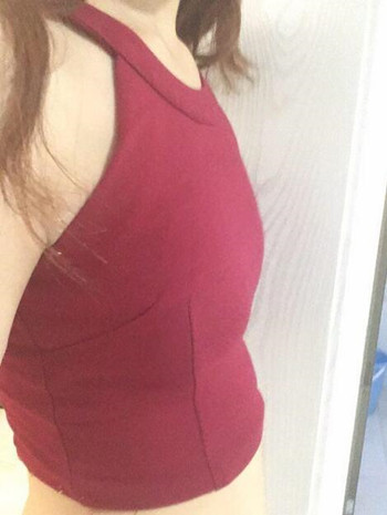 假體隆胸術后成功擺脫小學生身材，立現(xiàn)性感身材
