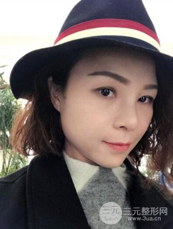 隆鼻整形手術(shù)真人案例恢復(fù)過程分享 附上果圖