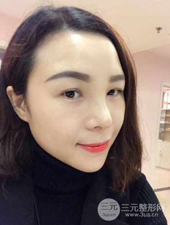 隆鼻整形手術(shù)真人案例恢復(fù)過程分享 附上果圖