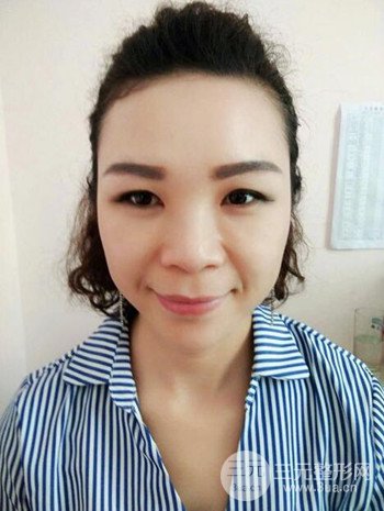隆鼻整形手術(shù)真人案例恢復(fù)過程分享 附上果圖