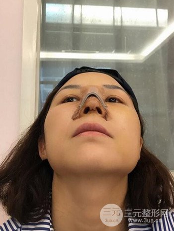 隆鼻整形手術(shù)真人案例恢復(fù)過程分享 附上果圖