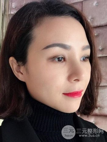 隆鼻整形手術(shù)真人案例恢復(fù)過程分享 附上果圖
