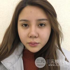 昆明吳氏嘉美李明硅膠隆鼻前后對比圖恢復(fù)心情小札