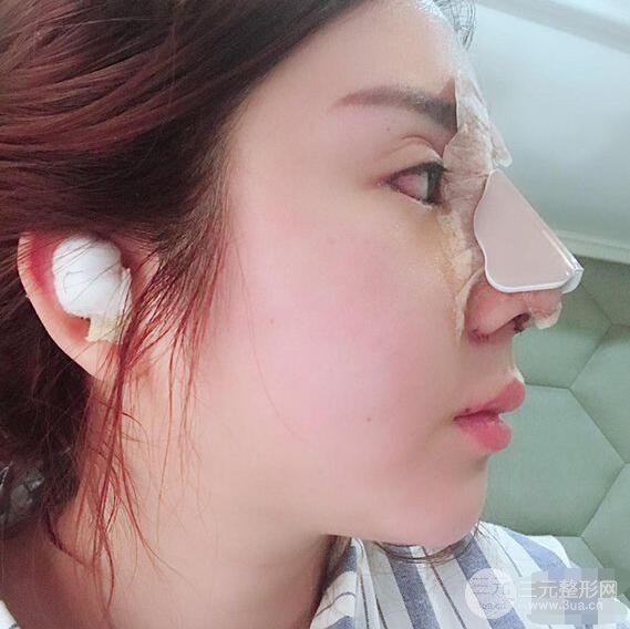 昆明吳氏嘉美李明硅膠隆鼻前后對比圖恢復(fù)心情小札
