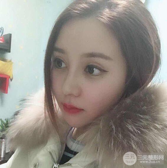 昆明吳氏嘉美李明硅膠隆鼻前后對比圖恢復(fù)心情小札