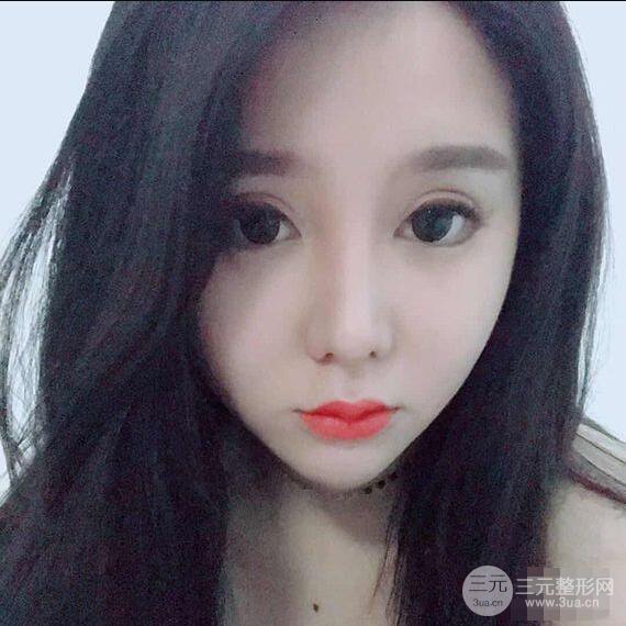 昆明吳氏嘉美李明硅膠隆鼻前后對比圖恢復(fù)心情小札