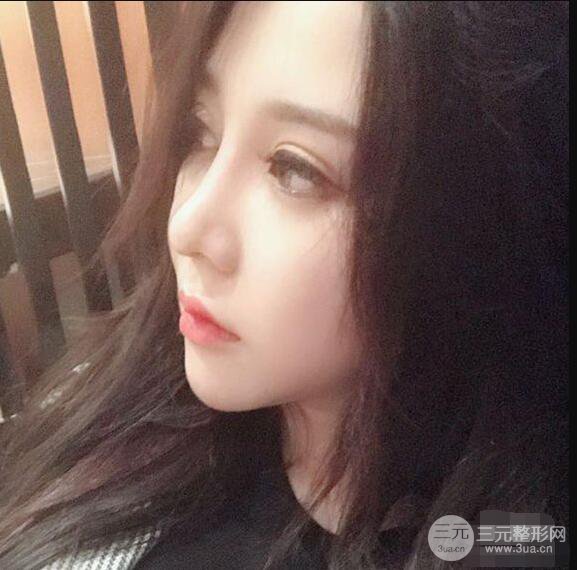 昆明吳氏嘉美李明硅膠隆鼻前后對比圖恢復(fù)心情小札