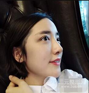 杭州格萊美張樹功假體隆鼻前后對比圖|內附恢復心情變化哦