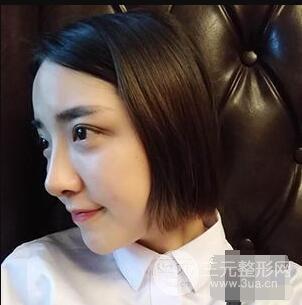 杭州格萊美張樹功假體隆鼻前后對比圖|內附恢復心情變化哦