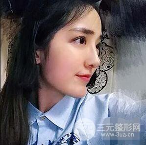 杭州格萊美張樹功假體隆鼻前后對比圖|內附恢復心情變化哦