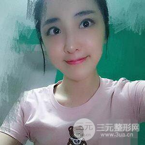 杭州格萊美張樹功假體隆鼻前后對比圖|內附恢復心情變化哦