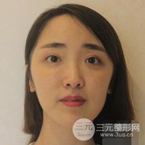 杭州格萊美張樹功假體隆鼻前后對比圖|內附恢復心情變化哦