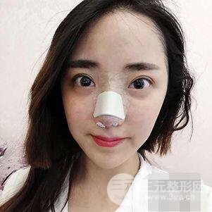 杭州格萊美張樹功假體隆鼻前后對比圖|內附恢復心情變化哦