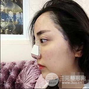 杭州格萊美張樹功假體隆鼻前后對比圖|內附恢復心情變化哦