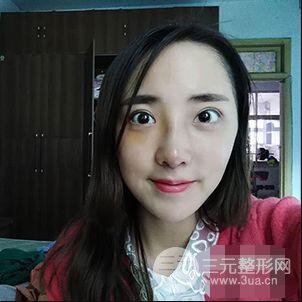 杭州格萊美張樹功假體隆鼻前后對比圖|內附恢復心情變化哦
