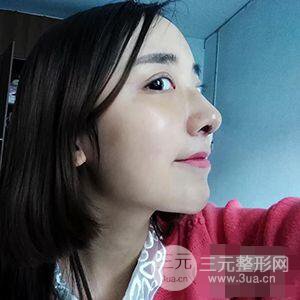 杭州格萊美張樹功假體隆鼻前后對比圖|內附恢復心情變化哦