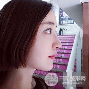 杭州格萊美張樹功假體隆鼻前后對比圖|內附恢復心情變化哦