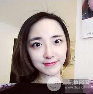 杭州格萊美張樹功假體隆鼻前后對比圖|內附恢復心情變化哦