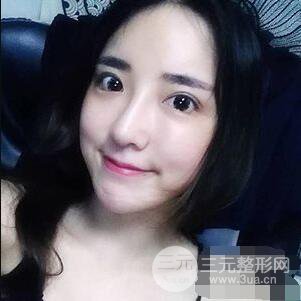 杭州格萊美張樹功假體隆鼻前后對比圖|內附恢復心情變化哦
