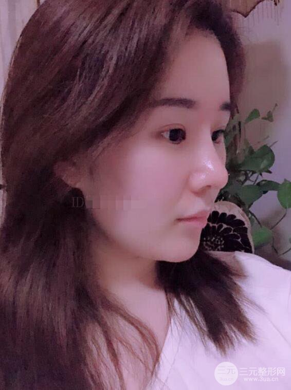 上海華美李庭勛膨體隆鼻前后對比圖一個月恢復心情日記